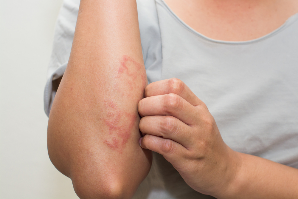 Great Eczema Advice That Anyone Can Use