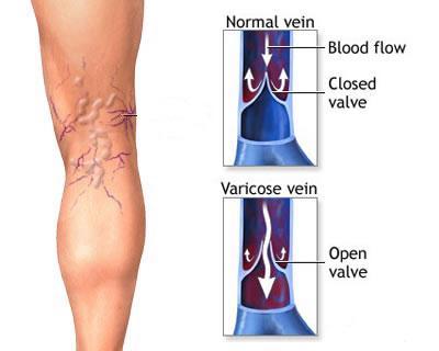 Varicose Veins Treatment Cream